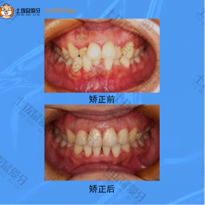 牙齿重度拥挤不齐，个别牙齿反颌，矫正案例
