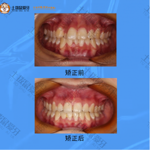 牙齿拥挤，个别牙齿反颌，牙齿矫正案例