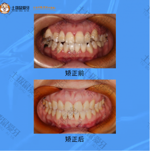 虎牙高突，牙齿不整齐，矫正案例