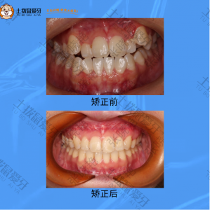 牙齿拥挤不齐，虎牙外突，牙齿矫正案例
