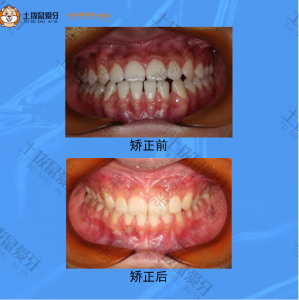 下颌牙齿间隙大，牙齿矫正案例
