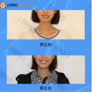 牙齿前突，安氏I类，骨性I类，牙齿矫正案例