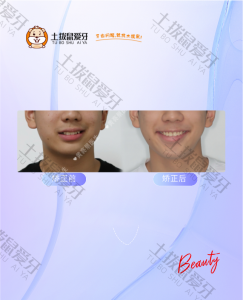 牙齿拥挤不齐+虎牙突出，牙齿矫正案例