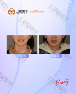 成人牙齿拥挤不齐+虎牙高突，牙齿矫正案例