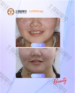 牙齿拥挤不齐，咬合不齐，牙齿矫正案例