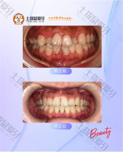 牙齿拥挤不齐，2号牙齿反颌，牙齿矫正案例