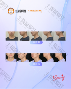 成人男士牙齿龅牙矫正案例