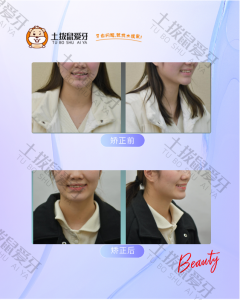 成人女士牙齿拥挤不整齐，矫正案例