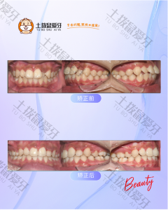 牙齿外凸+2号牙齿反颌，牙齿矫正案例