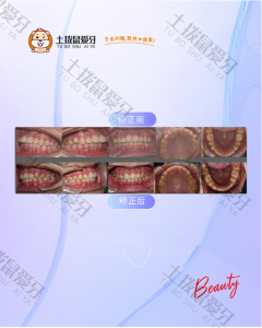 牙齿深覆盖+门牙有缝隙，牙齿矫正案例