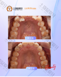 22岁小帅哥，牙齿拥挤严重，虎牙高凸，牙弓形态异常