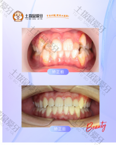 儿童牙齿重度度拥挤 ，非拔牙全口矫正