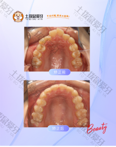 女士龅牙、门牙扭转、中线不齐矫正案例