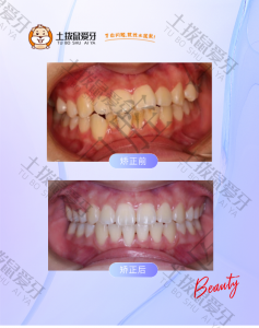 深覆盖加牙列不齐2年矫正案例