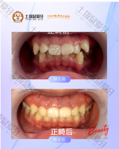 男生牙齿拥挤、深覆盖、虎牙高突案例