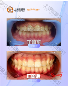 男士牙齿拥挤、门牙扭转案例