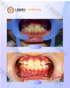 男生地包天、下牙反颌正畸案例