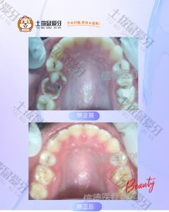 牙齿不齐，多颗上颌后牙严重龋坏