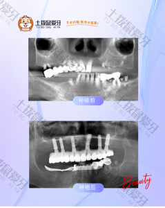 术前术后口内x光照