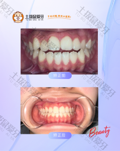 开颌、牙列不齐、面型偏左矫正