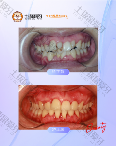 牙列不齐多生牙拔牙陶瓷托槽矫治