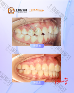 牙列不齐牙齿突拔牙内收排齐