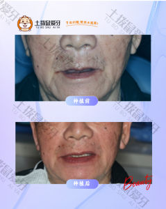 全口无牙颌种植后即刻负重案例