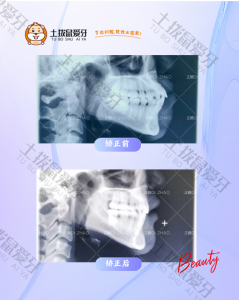 双颌前突正畸治疗，改善面型