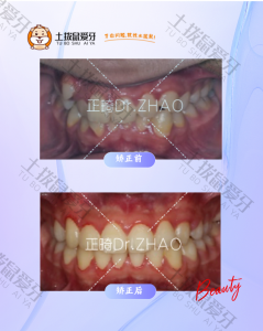 牙列重度拥挤的非拔牙正畸治疗