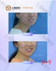骨性II类的龅牙嘴突治疗，改善凸面型