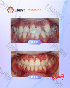 牙列重度拥挤的拔牙正畸治疗