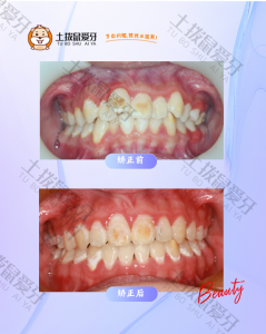 牙列拥挤，门牙前突矫正案例