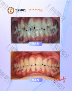 深覆盖，牙弓前突拔牙矫正