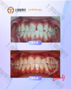 牙列稀疏，门牙缝隙明显，正畸