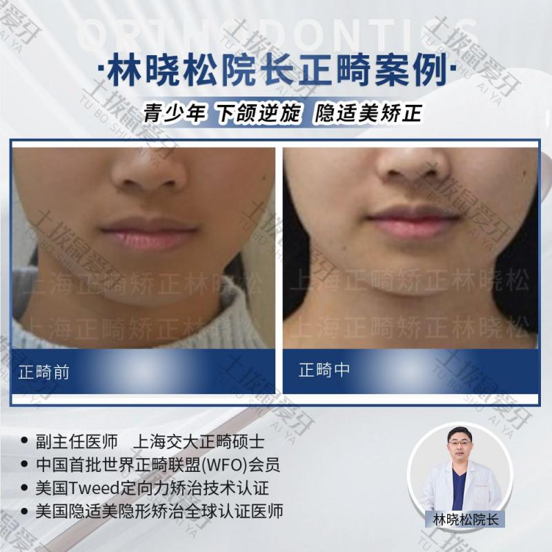 青少年隐适美矫正下颌逆旋