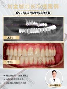 刘金城主任全口即拔即种即刻修复案例