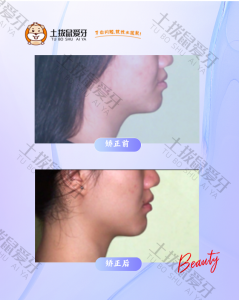 18岁女生，牙列拥挤，中线不齐矫正案例