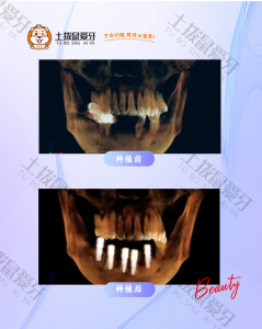 男子半口牙缺失种植修复