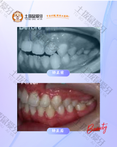 患者开合无法咬断面条求治，正畸案例