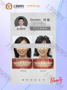 女士龅牙，门牙扭转，牙齿轻度拥挤正畸案例