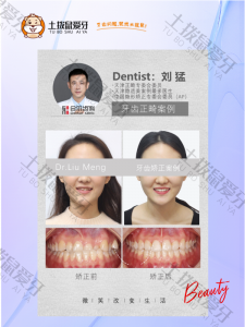 女士前牙反颌、补拔牙正畸案例