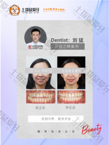 女孩牙齿开合，牙齿轻度不齐正畸案例
