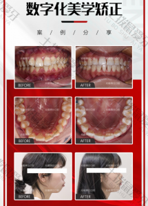 牙齿扭转，深覆盖隐形矫正案例