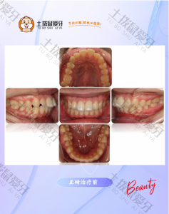 深覆盖嘴突舌侧矫正案例