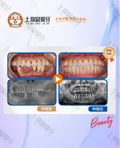 58岁女士，下面牙齿就剩4颗了，不好吃饭。