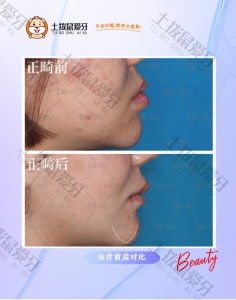 牙齿不齐反颌尖牙高突正畸方案