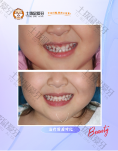 3岁半女童乳牙期反颌咬合不佳矫正