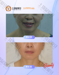 女士中度牙齿拥挤，牙齿不齐矫正案例