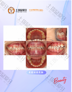 反颌（地包天）经典正畸案例