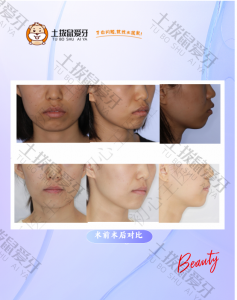 露龈笑经典治疗案例